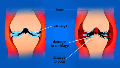 Normal and arthritic knee